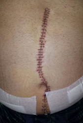 Scar 10 days after surgery. YOu can also wee where the drainage tubes were located.
